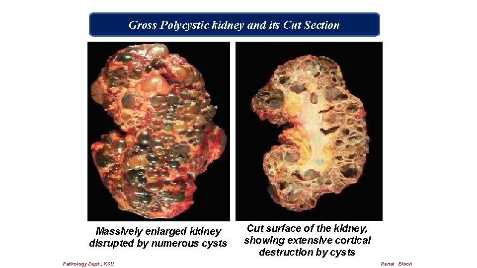 Gross Polycystic kidney and its Cut Section Massively enlarged kidney disrupted by numerous cysts