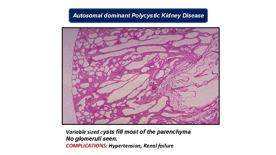 Autosomal dominant Polycystic Kidney Disease Variable sized cysts fill most of the parenchyma No