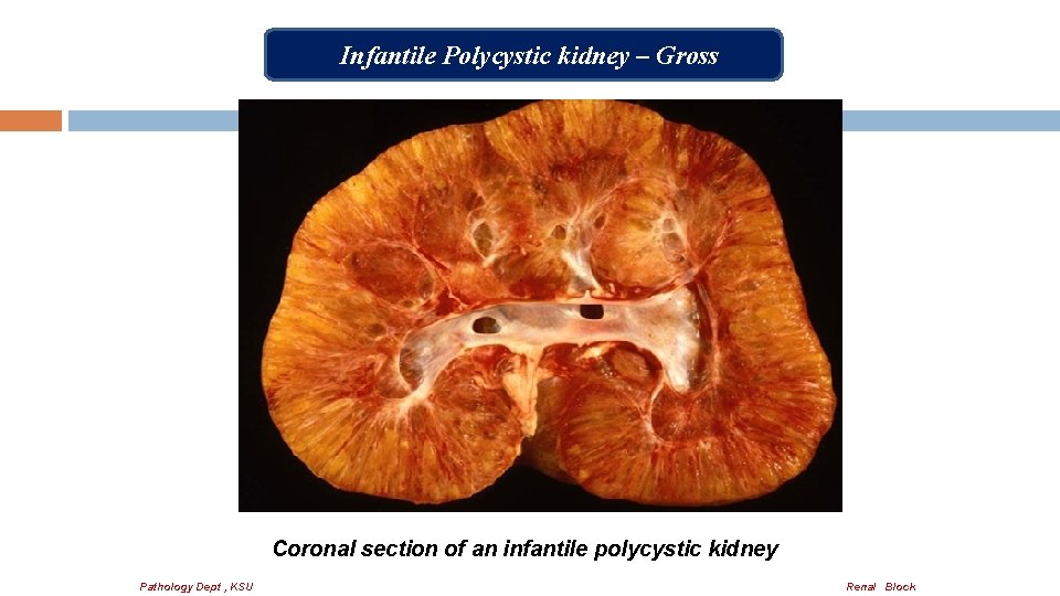 Infantile Polycystic kidney – Gross Coronal section of an infantile polycystic kidney Pathology Dept