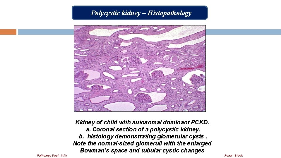 Polycystic kidney – Histopathology Kidney of child with autosomal dominant PCKD. a. Coronal section