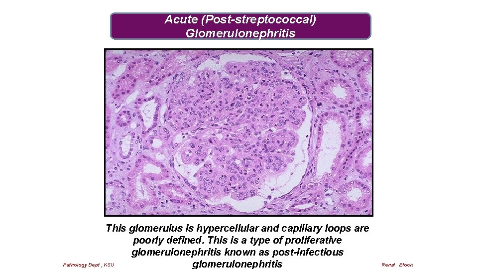 Acute (Post-streptococcal) Glomerulonephritis This glomerulus is hypercellular and capillary loops are poorly defined. This