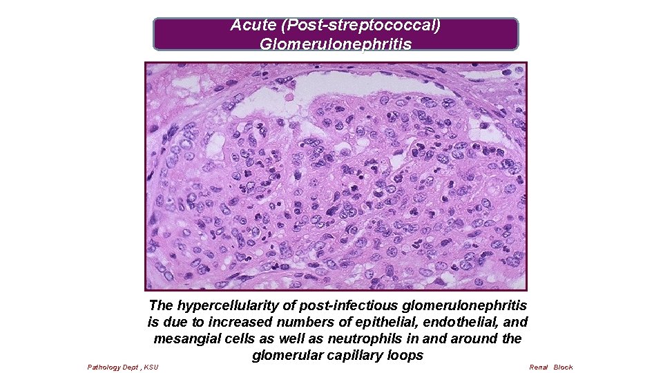 Acute (Post-streptococcal) Glomerulonephritis The hypercellularity of post-infectious glomerulonephritis is due to increased numbers of
