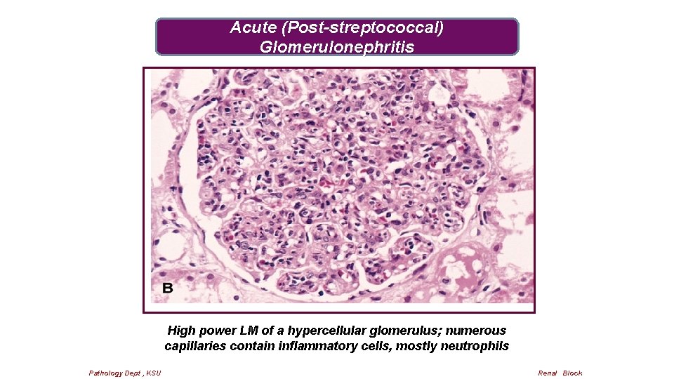 Acute (Post-streptococcal) Glomerulonephritis High power LM of a hypercellular glomerulus; numerous capillaries contain inflammatory