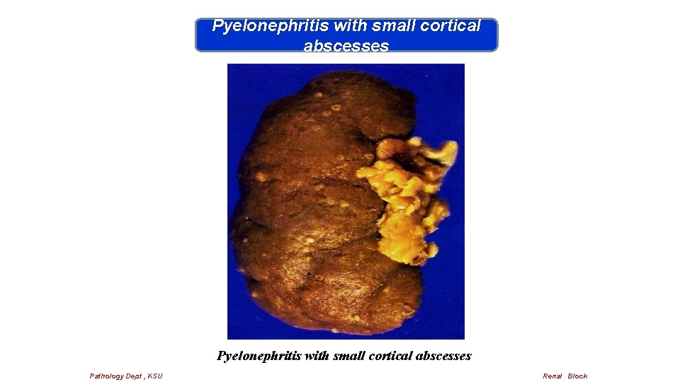 Pyelonephritis with small cortical abscesses Pathology Dept , KSU Renal Block 