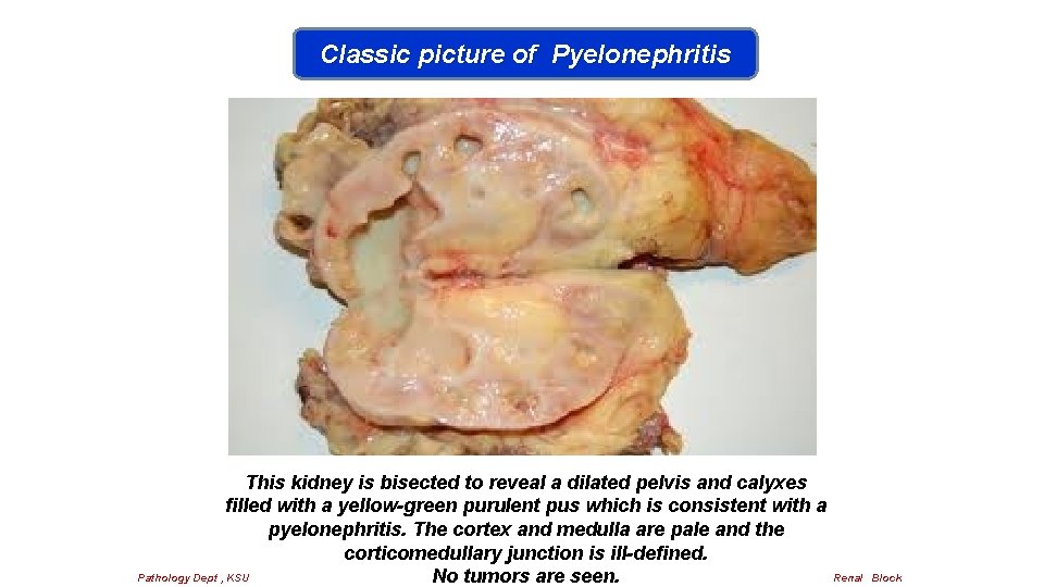 Classic picture of Pyelonephritis This kidney is bisected to reveal a dilated pelvis and