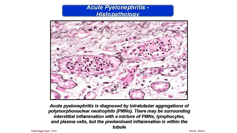 Acute Pyelonephritis Histopathology Acute pyelonephritis is diagnosed by intratubular aggregations of polymorphonuclear neutrophils (PMNs).