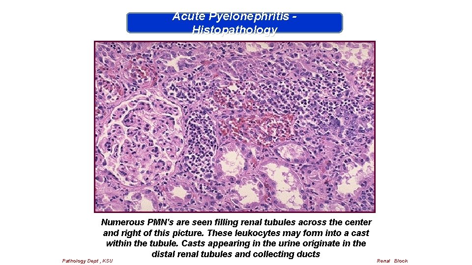 Acute Pyelonephritis Histopathology Numerous PMN's are seen filling renal tubules across the center and
