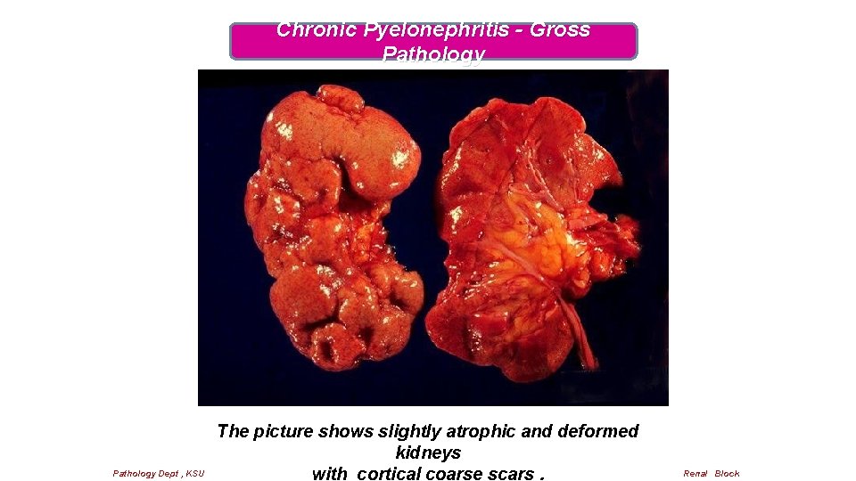 Chronic Pyelonephritis - Gross Pathology Dept , KSU The picture shows slightly atrophic and