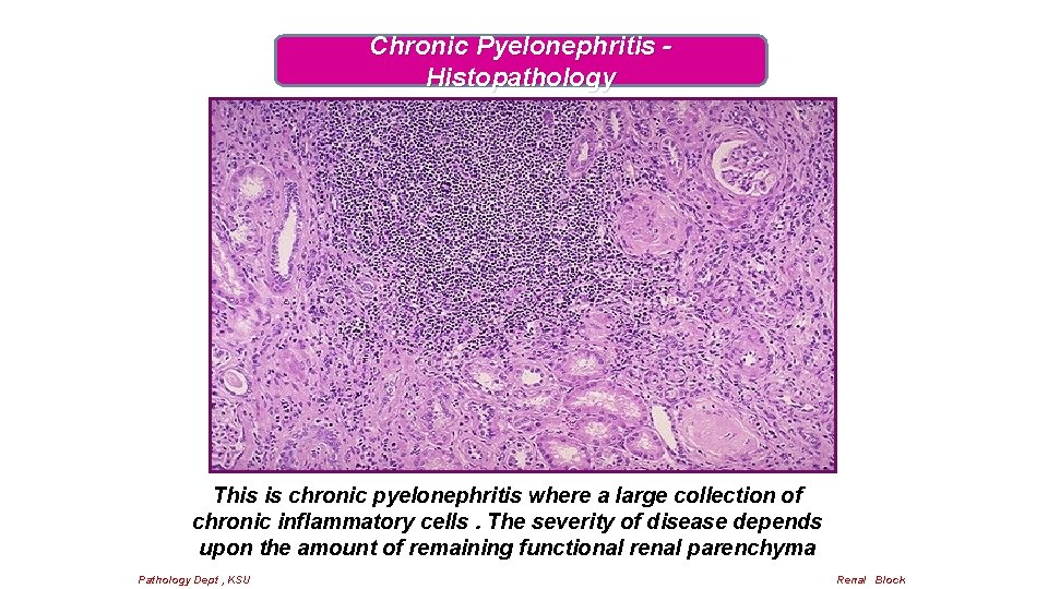 Chronic Pyelonephritis Histopathology This is chronic pyelonephritis where a large collection of chronic inflammatory