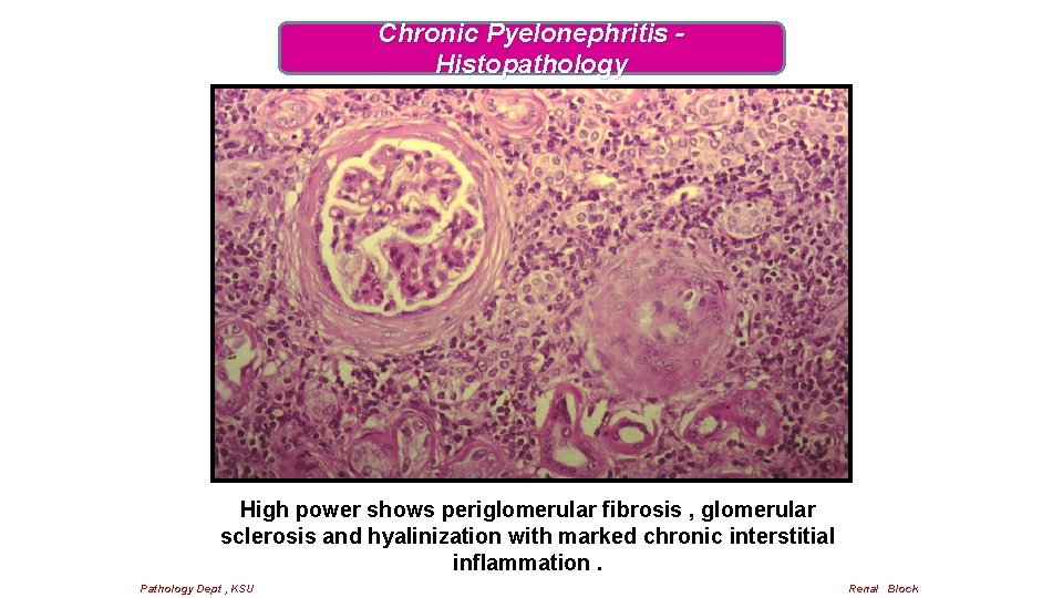 Chronic Pyelonephritis Histopathology High power shows periglomerular fibrosis , glomerular sclerosis and hyalinization with