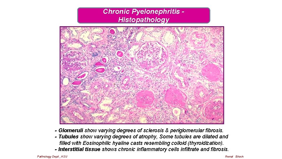 Chronic Pyelonephritis Histopathology - Glomeruli show varying degrees of sclerosis & periglomerular fibrosis. -