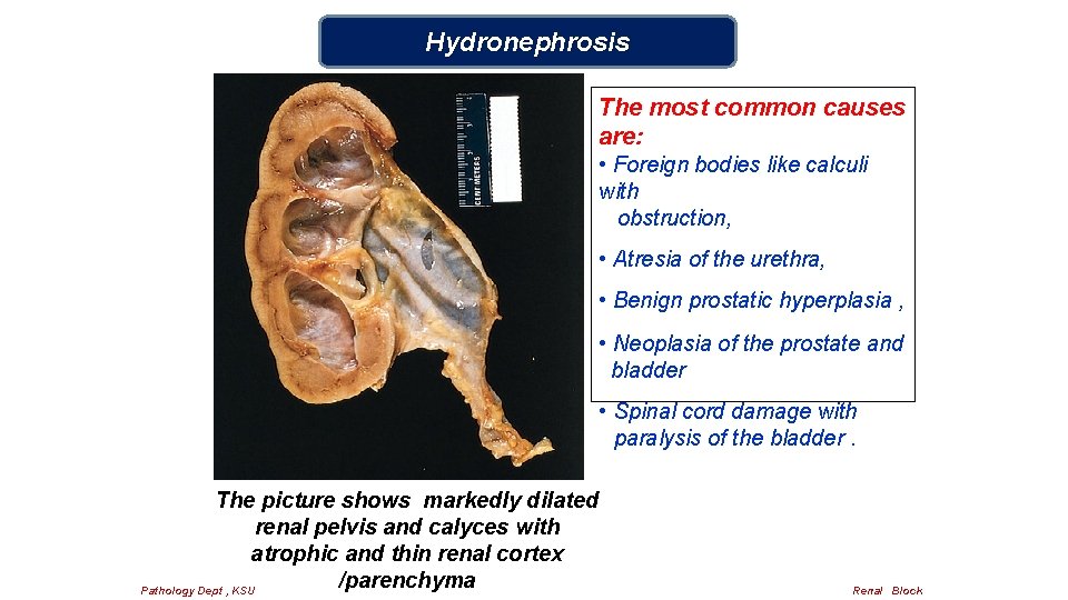 Hydronephrosis The most common causes are: • Foreign bodies like calculi with obstruction, •