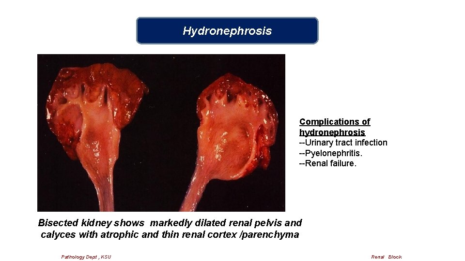 Hydronephrosis Complications of hydronephrosis --Urinary tract infection --Pyelonephritis. --Renal failure. Bisected kidney shows markedly