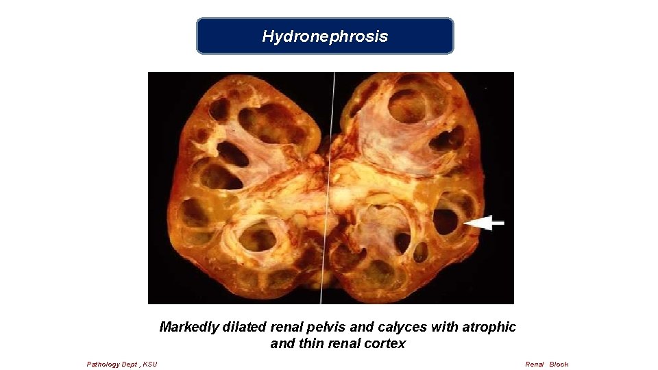 Hydronephrosis Markedly dilated renal pelvis and calyces with atrophic and thin renal cortex Pathology