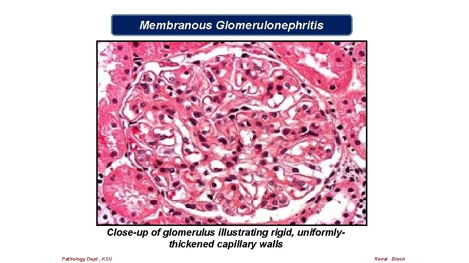 Membranous Glomerulonephritis Close-up of glomerulus illustrating rigid, uniformlythickened capillary walls Pathology Dept , KSU