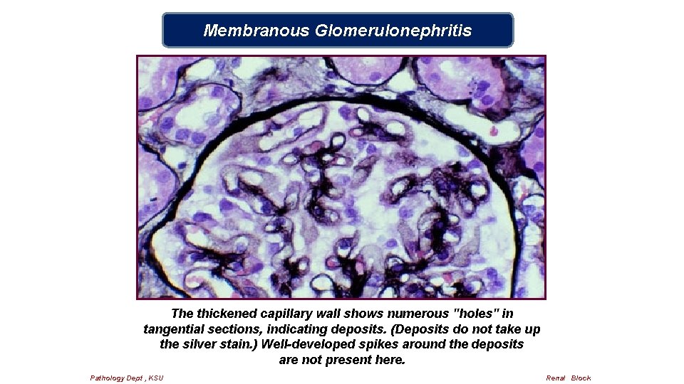 Membranous Glomerulonephritis The thickened capillary wall shows numerous "holes" in tangential sections, indicating deposits.