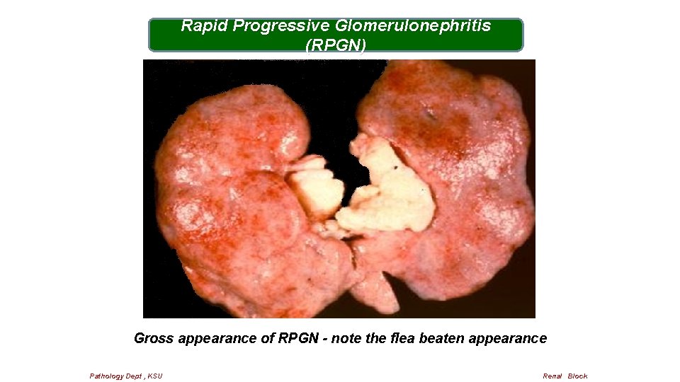 Rapid Progressive Glomerulonephritis (RPGN) Gross appearance of RPGN - note the flea beaten appearance