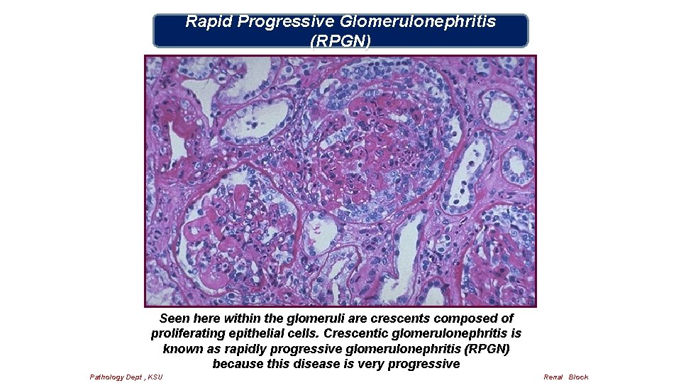 Rapid Progressive Glomerulonephritis (RPGN) Seen here within the glomeruli are crescents composed of proliferating