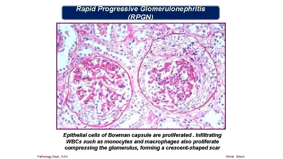 Rapid Progressive Glomerulonephritis (RPGN) Epithelial cells of Bowman capsule are proliferated. Infiltrating WBCs such