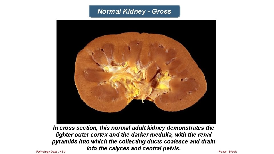 Normal Kidney - Gross In cross section, this normal adult kidney demonstrates the lighter