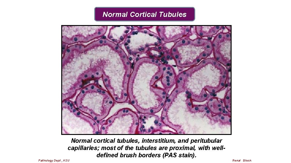 Normal Cortical Tubules Normal cortical tubules, interstitium, and peritubular capillaries; most of the tubules