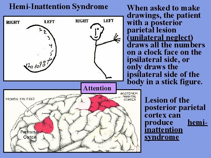 Hemi-Inattention Syndrome Attention When asked to make drawings, the patient with a posterior parietal