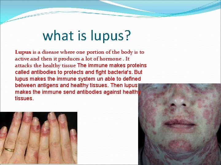 what is lupus? Lupus is a disease where one portion of the body is
