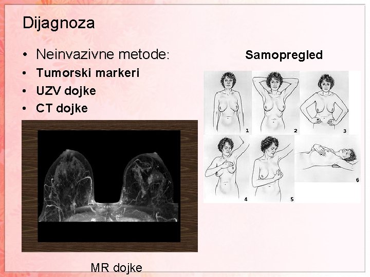 Dijagnoza • Neinvazivne metode: • Tumorski markeri • UZV dojke • CT dojke MR