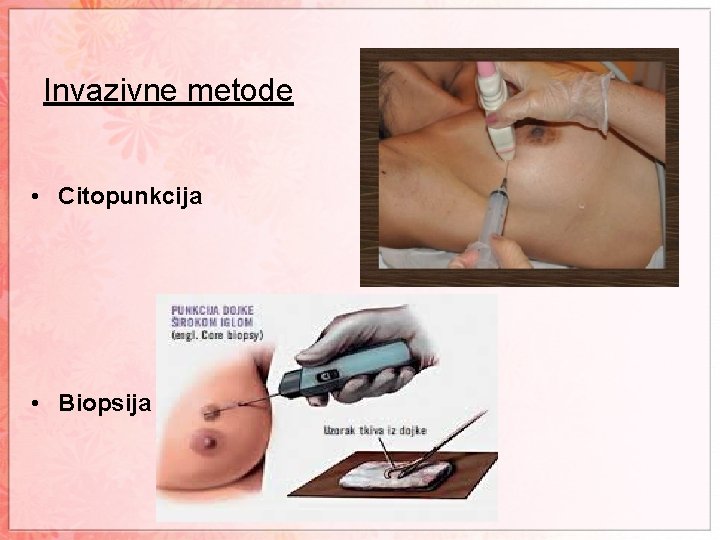 Invazivne metode • Citopunkcija • Biopsija 
