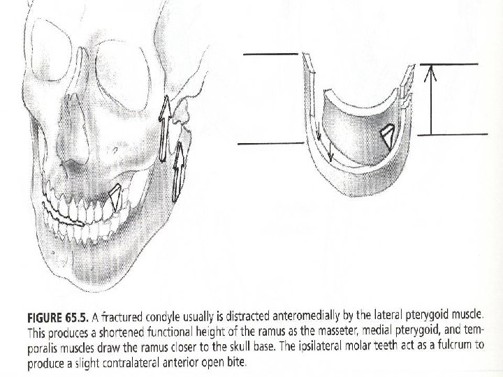 Picture of open bites 
