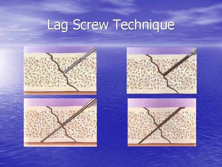 Lag Screw Technique 