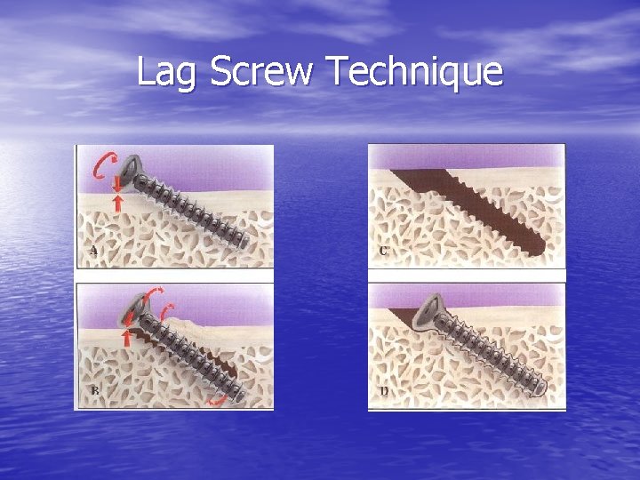 Lag Screw Technique 