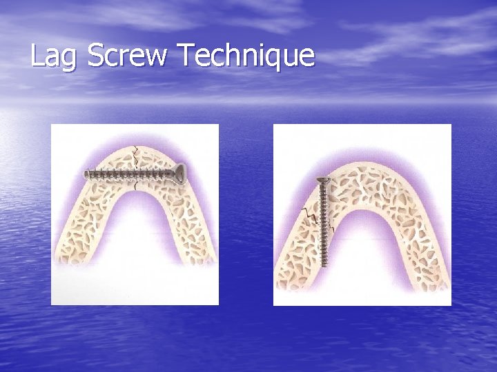 Lag Screw Technique 