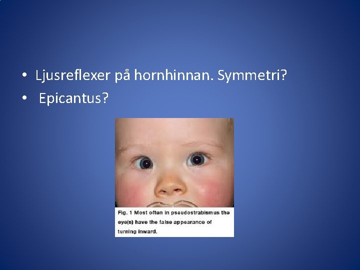  • Ljusreflexer på hornhinnan. Symmetri? • Epicantus? 