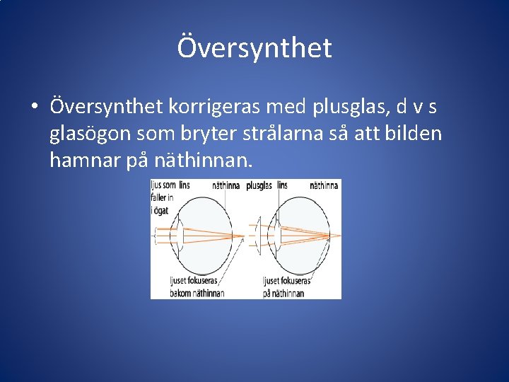 Översynthet • Översynthet korrigeras med plusglas, d v s glasögon som bryter strålarna så