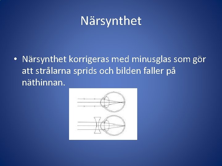 Närsynthet • Närsynthet korrigeras med minusglas som gör att strålarna sprids och bilden faller