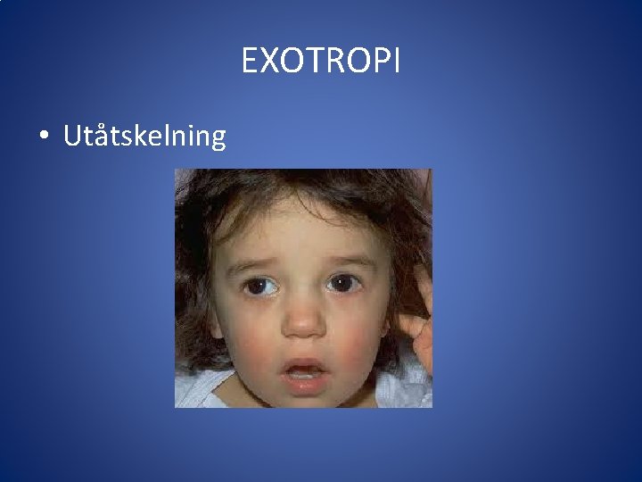 EXOTROPI • Utåtskelning 