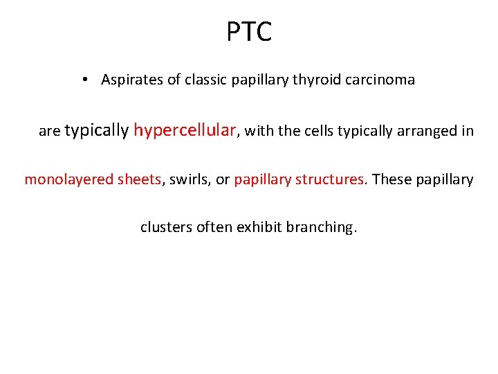 PTC • Aspirates of classic papillary thyroid carcinoma are typically hypercellular, with the cells