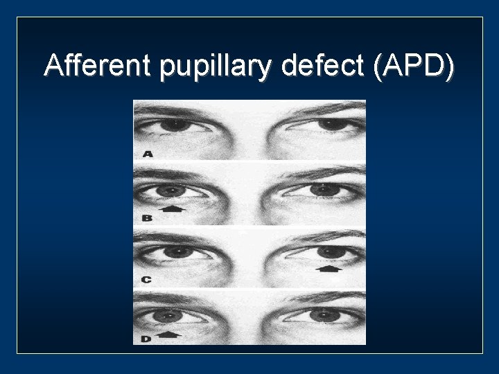Afferent pupillary defect (APD) 