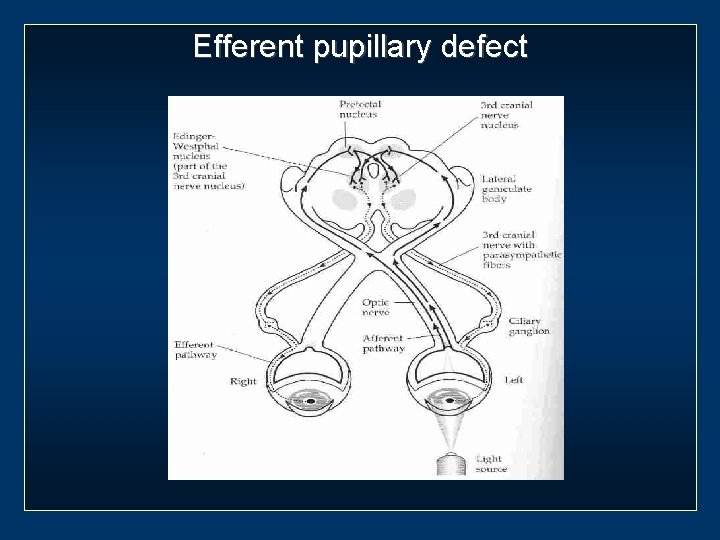 Efferent pupillary defect 