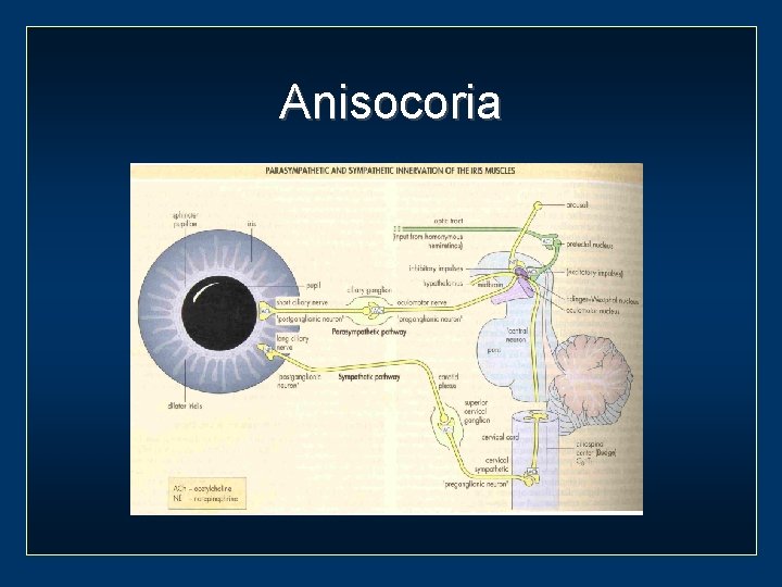 Anisocoria 