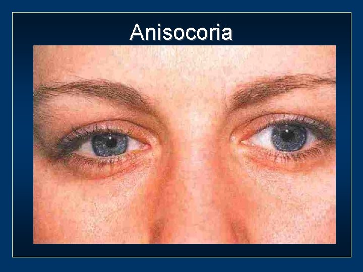 Anisocoria 