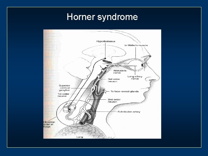 Horner syndrome 