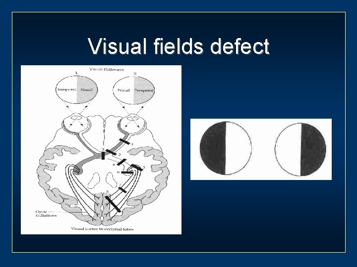 Visual fields defect 