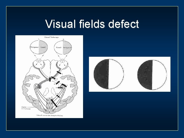 Visual fields defect 