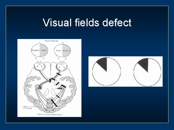 Visual fields defect 