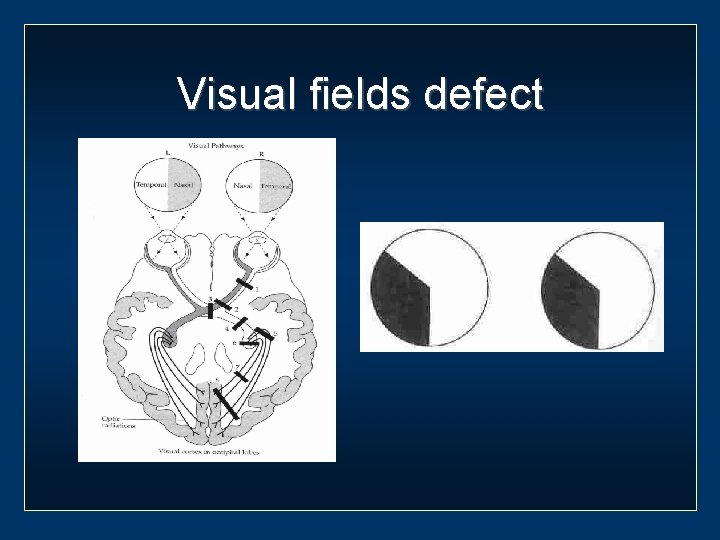 Visual fields defect 