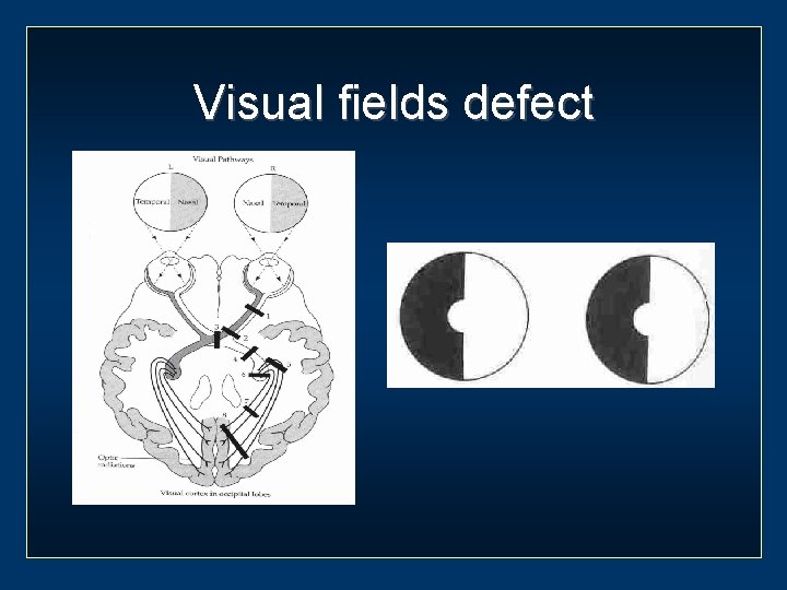 Visual fields defect 
