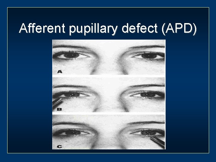 Afferent pupillary defect (APD) 