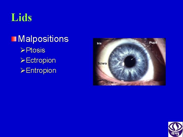 Lids Malpositions ØPtosis ØEctropion ØEntropion 